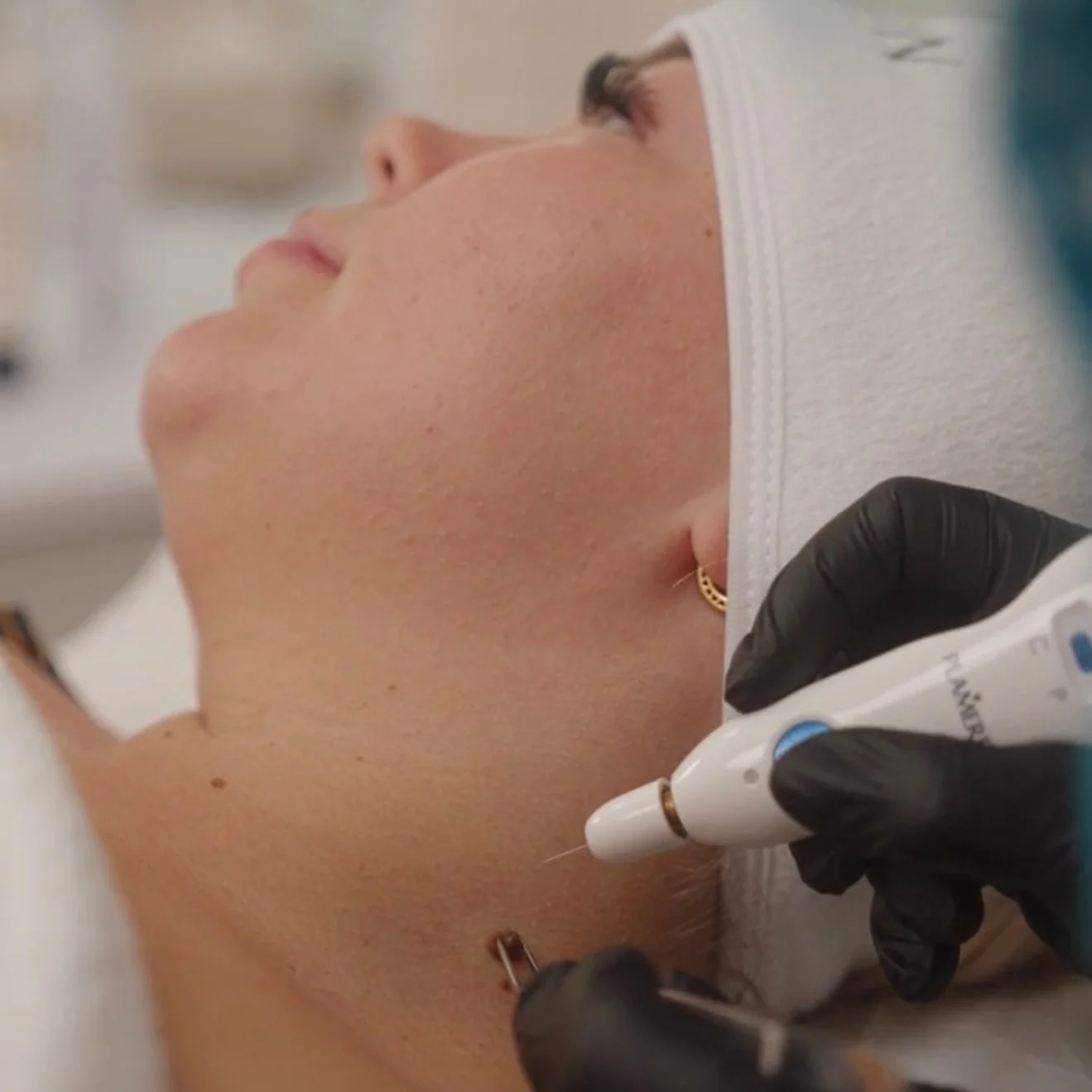 Plasmapen-behandling mot skin tags hos Millisskönhetskrypin